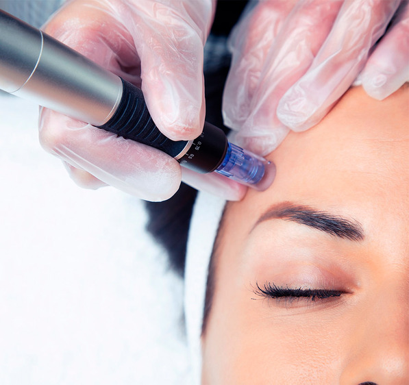 Microneedling con dermapen